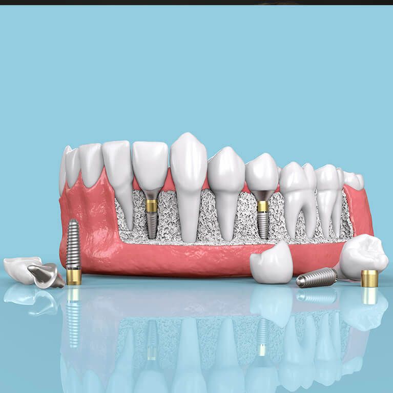 Limpieza dental profesional